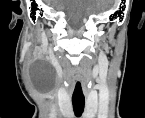 Second Branchial Cleft Cyst Image