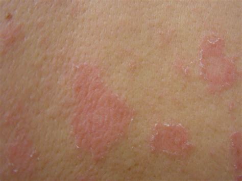 Pityriasis Rosea African American