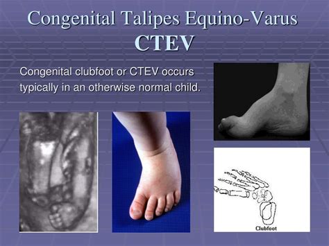 Ppt Congenital Talipes Equino Varus Congenital Clubfoot Powerpoint