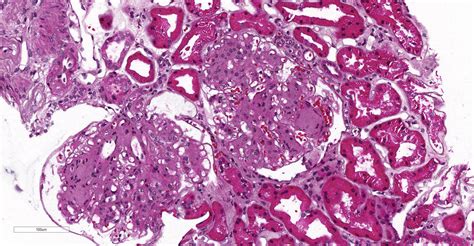 Pathology Outlines Diabetic Kidney Disease