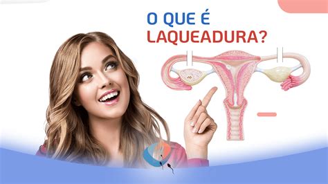 Vantagens E Desvantagens Laqueadura