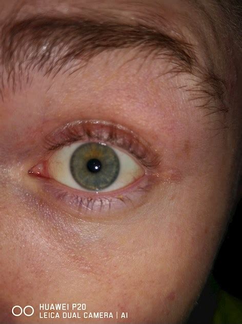 How To Get Rid Of Yellow Eyes Jaundice Teethwalls