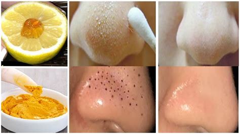 How To Remove Blackheads And Whiteheads From Nose And Face Naturally At
