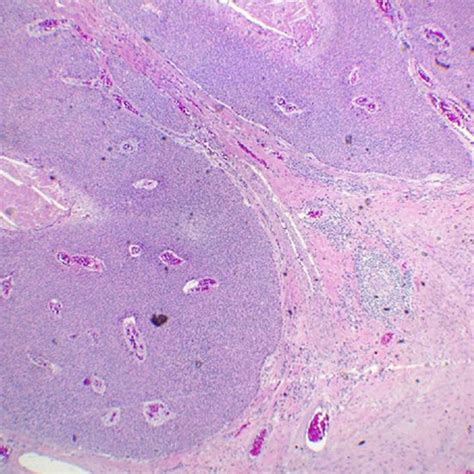 Eccrine Porocarcinoma With Necrosis Area Seen At 20x Magnification