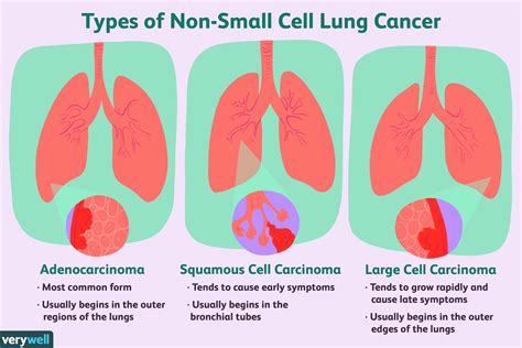 Najczęstsze Typy Raka Płuc Medycyna