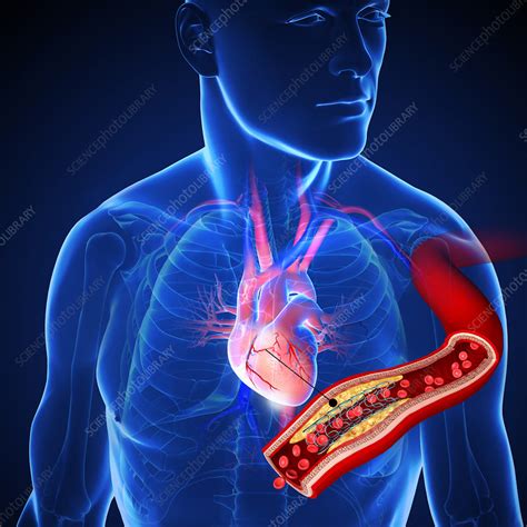 Angioplasty With Stent Placement Illustration Stock Image C046