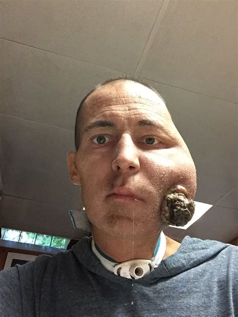 This Man Lost Half His Face To Cancer But Had It Rebuilt