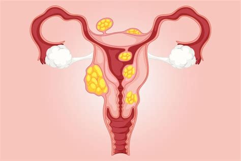 Myomectomy Edges Embolization For Uterine Fibroids Medpage Today