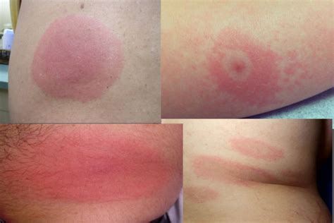 What Does A Lyme Disease Rash Look Like Daniel Cameron Md Mph