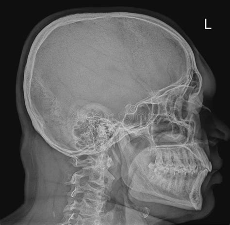 Lateral Skull X Ray Radiograph Stock Image Image Of Anatomy Bones