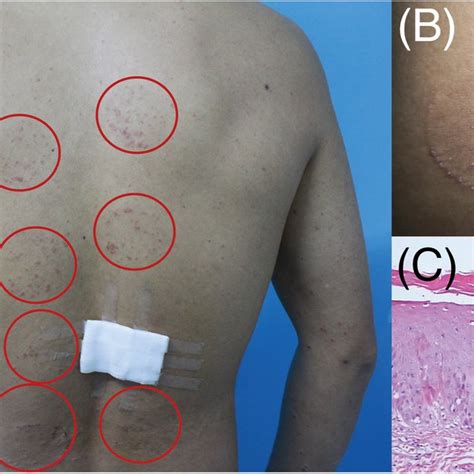 Koebner Phenomenon Induced By Cupping Therapy In The Unstable Stage Of