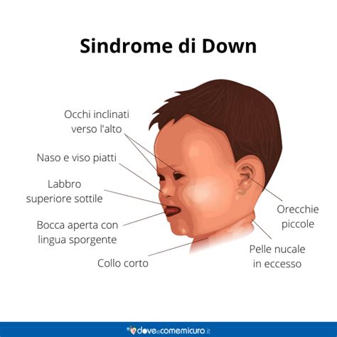 Sindrome di Down Trisomia cos è Cause e anomalia dei cromosomi