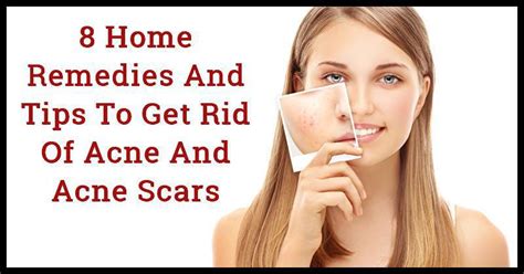 8 Home Remedies And Tips To Get Rid Of Acne And Acne Scars