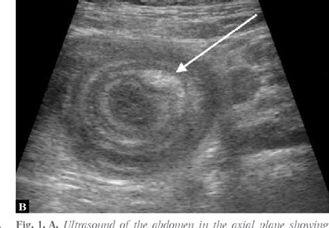 Figure 1 From Paediatric Small Bowel Intussusception On Ultrasound A