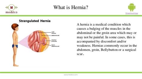 All About Hernia Causes Symptoms And Treatment