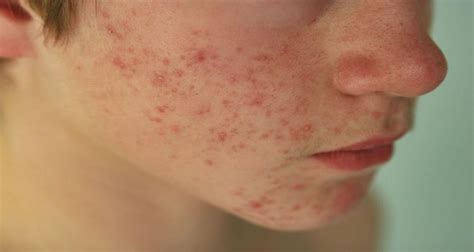 Skin Diseases A List Of Some Types And How To Treat Them