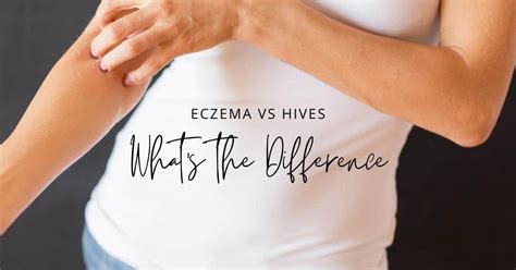 Eczema Vs Hives What S The Difference Enticare Ent Doctors Arizona