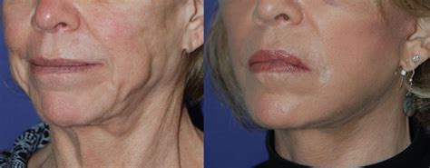 Best Instant Neck Lift Before And After Results Face Lift Surgery