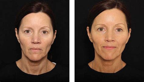 Thermage Before And After Photos Face 12 Facelift Info Prices