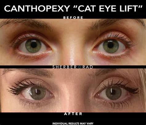 Cat Eye Reshaping Washington Dc Canthopexy Northern Va