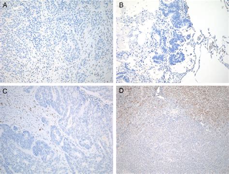 Immunohistochemical Staining Of P53 In Representative Tumors Harboring