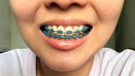 Incredible What Is The Best Color For Braces Quiz Ideas