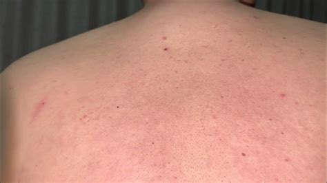 Back Pimple Popping Youtube