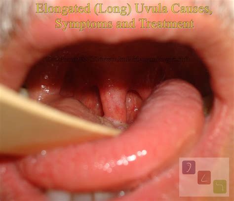 Elongated Long Uvula Causes Symptoms And Treatment 2022