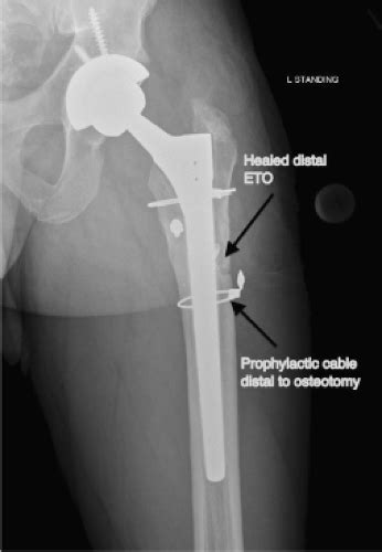 Use Of The Extended Trochanteric Osteotomy In Revision Total Hip
