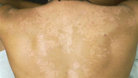 Tinea Versicolor Skin Condition Contour Dermatology