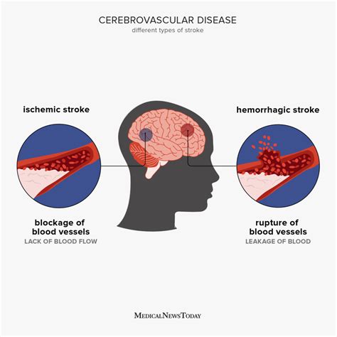 Cerebrovascular Disease Causes Symptoms And Treatment