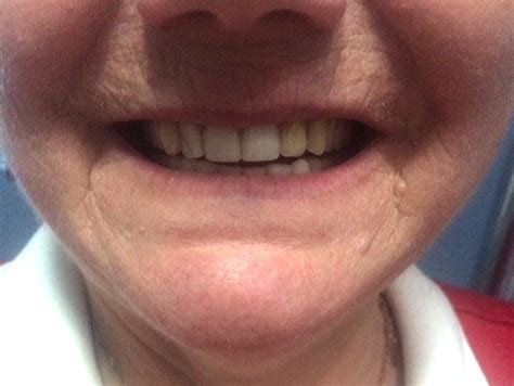 Precision Complete Upper And Lower Dentures Kelowna Denture Clinic