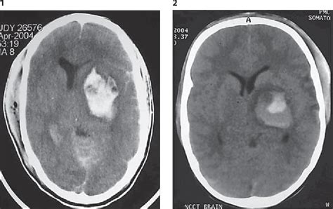Figure 1 From Outcome Of Pediatric Patients With Traumatic Basal