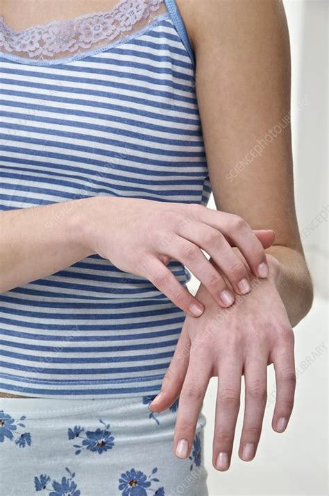 Itchy Hand Stock Image F0030471 Science Photo Library