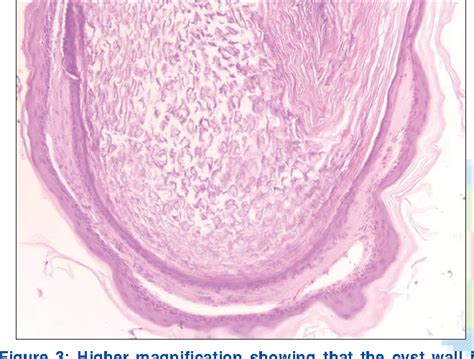 Figure 3 From Epidermal Inclusion Cyst Or Giant Milium Of The Nipple