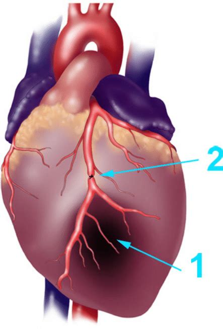 Schematic Diagram Of A Myocardial Infarction And Lad Ligation