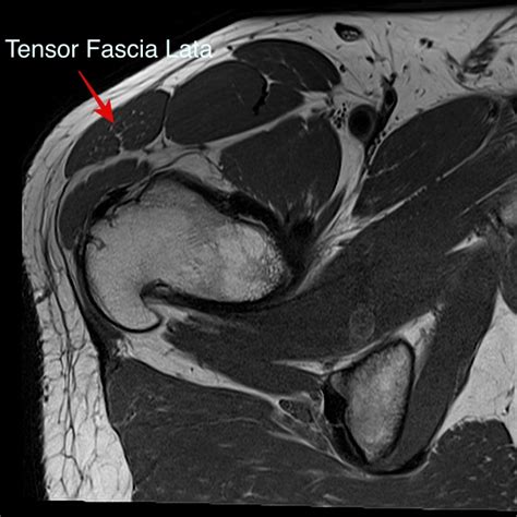 Hip Magnetic Resonance Imaging Recon Orthobullets