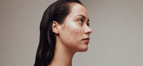 Acne Scars Treatment Mclean Potomac Dermatology