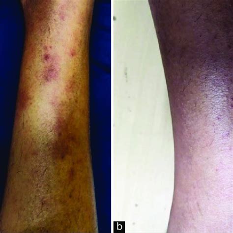 A Multiple Erythematous Macules And Rashes Over The Right Shin B