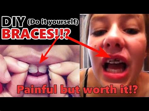 Fold the wax over your teeth. DIY (Do It Yourself) BRACES?!! Painful But Is it "WORTH IT ...