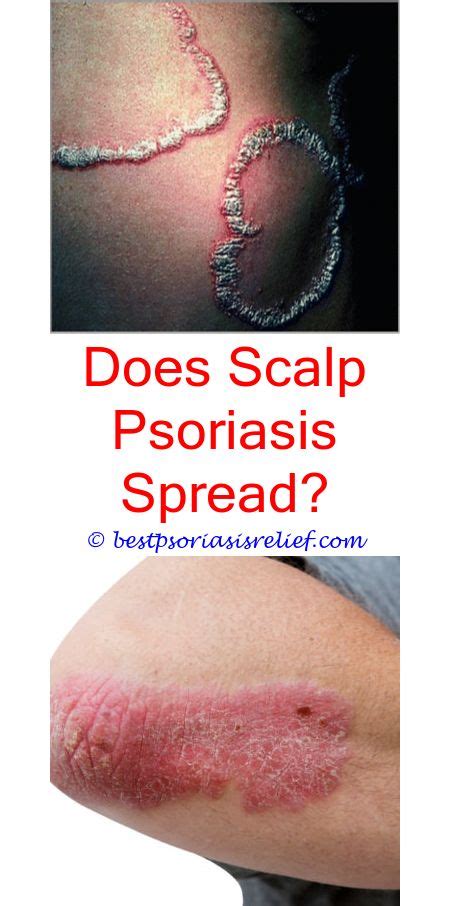 Pin On How To Treat Scalp Psoriasis