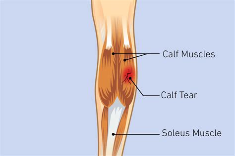 Calf Pain Causes Diagnosis And Treatment The Healthy