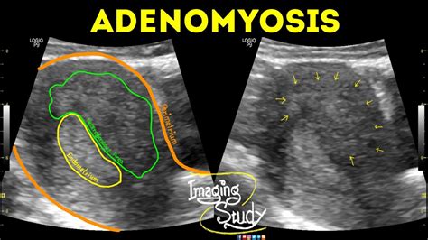 Adenomyosis Ultrasound Case 42 Youtube