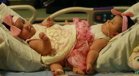 Conjoined Texas Twins Ximena And Scarlett Hernandez Torres Get Set