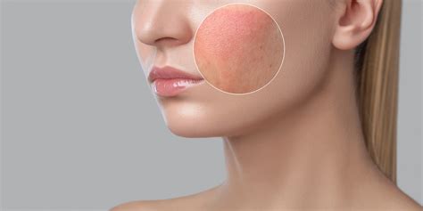 Common Types Of Skin Allergic Reactions Oak Brook Allergists