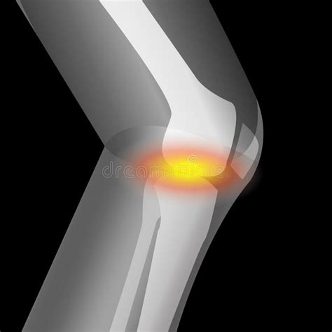 Arthritis In Knee Pain Of Knee Suffering From Knee Stock Vector