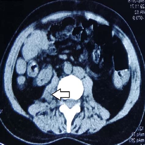 Ct Scan Showing Complete Resolution Of Iliopsoas Abscess Download