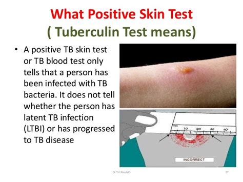 Diagnosis Of Tuberculosis An Update