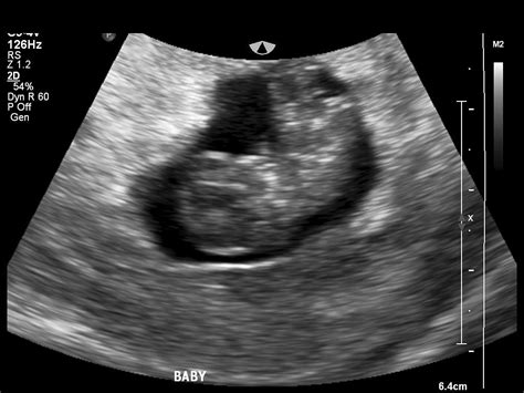 9 Week Ultrasound Babycenter