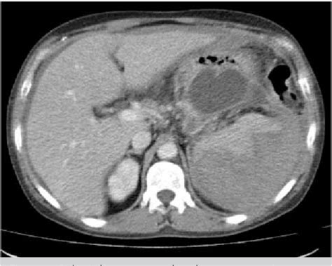 Figure 1 From A Rare Cause Of Acute Abdomen Splenic Hematoma And